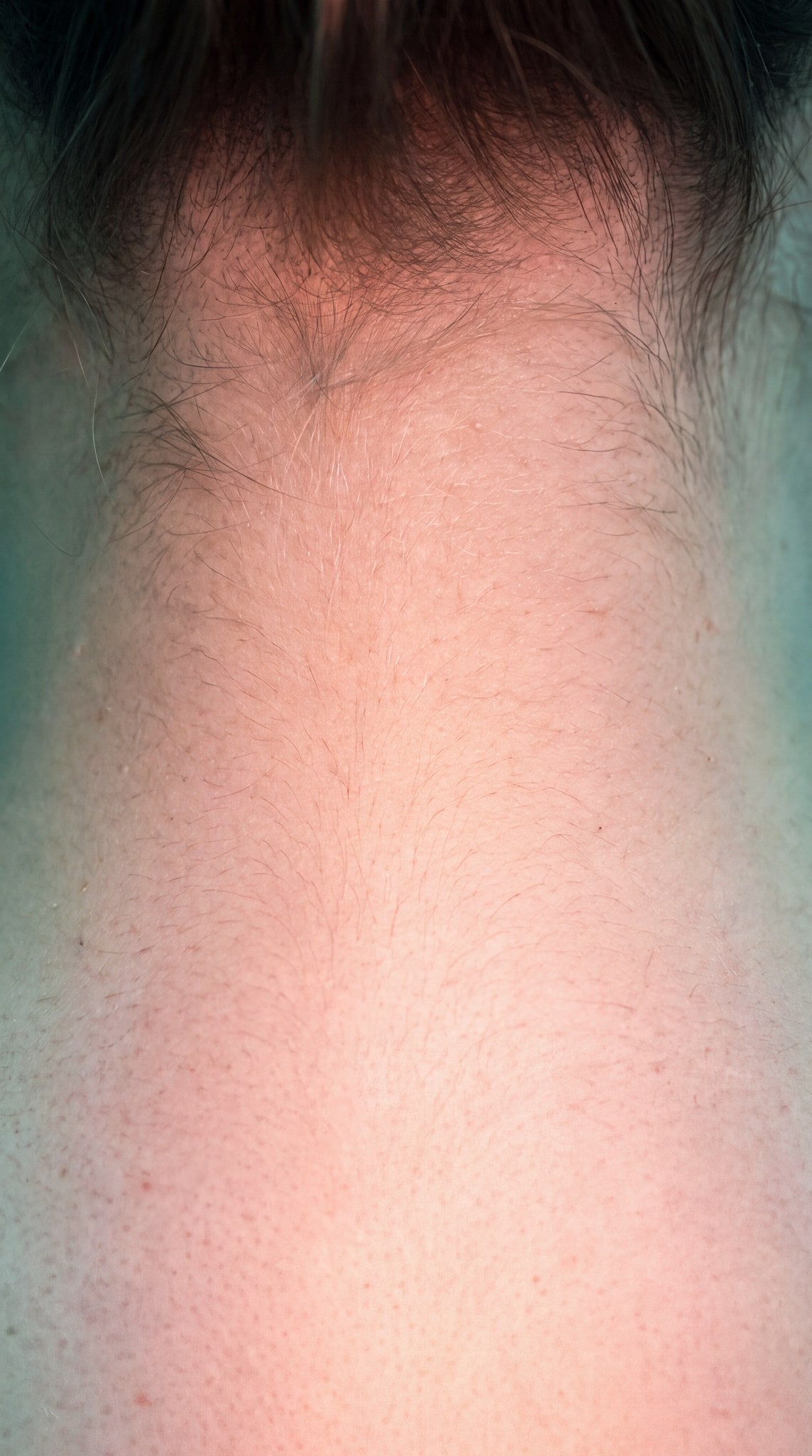Nape of the Neck Macro Study